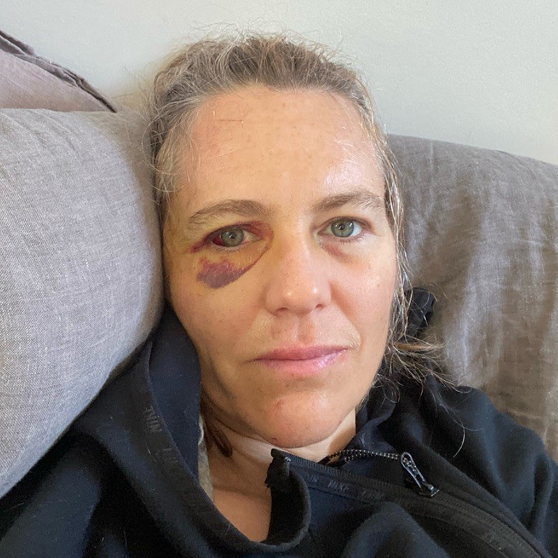 Triathlete Jocelyn Pepe recovering on the sofa after a concussion