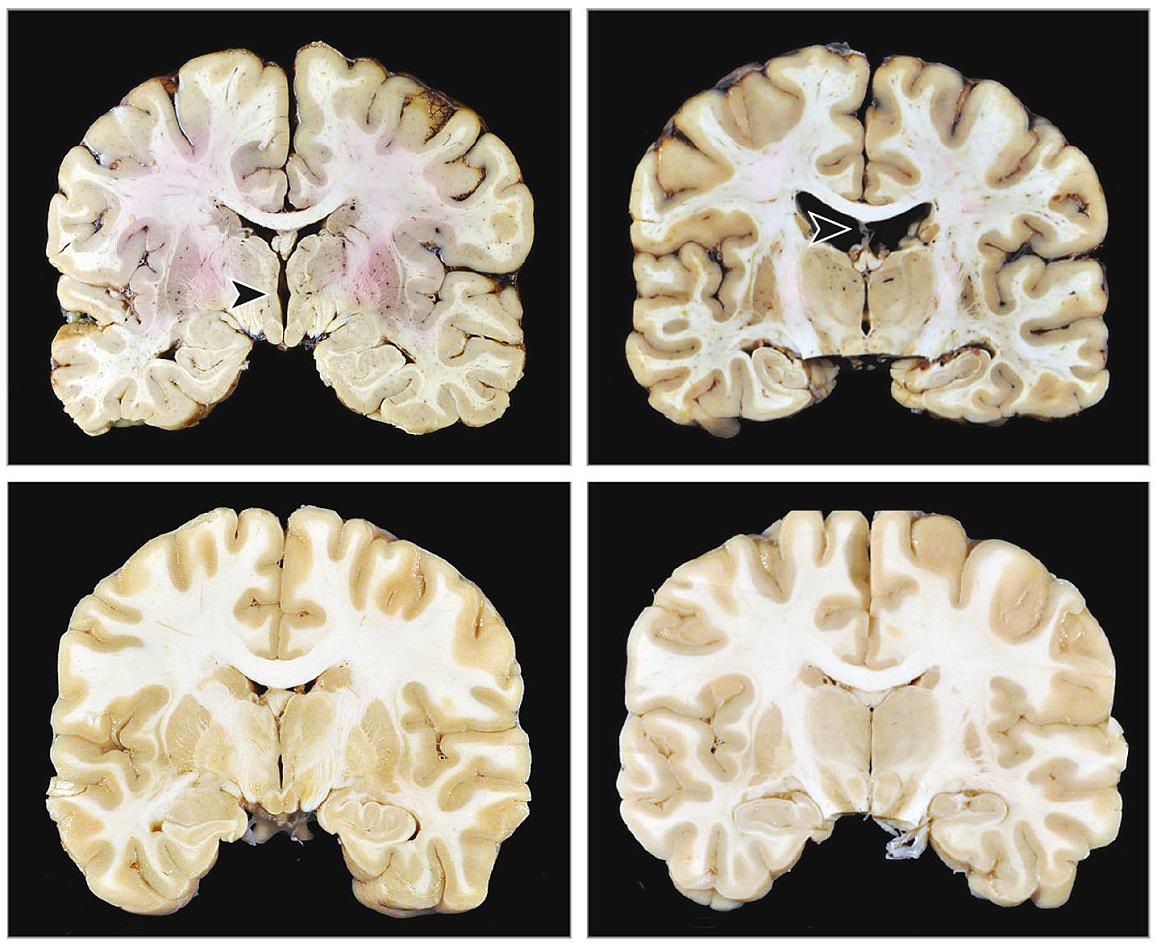 Slides comparing healthy brain tissue to damaged brain tissue